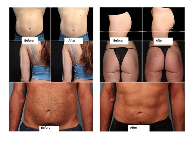 CHC Electro Magnetic Body Sculpt Pro Before and After