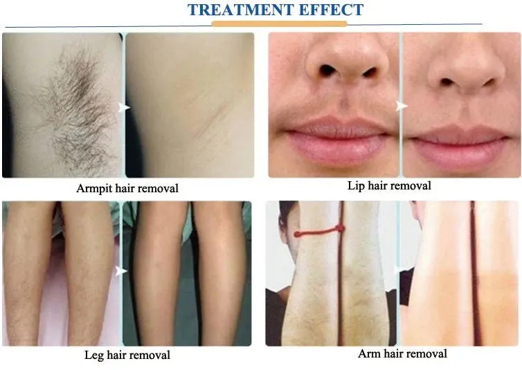 Hair removal effect
