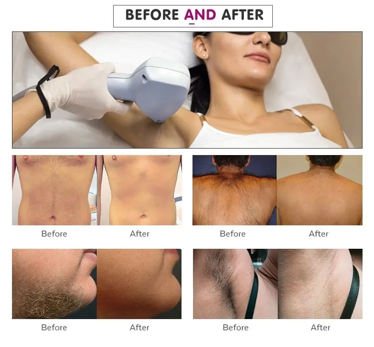 Hair removal effect