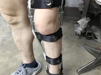 Blocco a molla dell'articolazione del ginocchio ortotico, è realizzato in lega di alluminio di alta qualità o acciaio inossidabile