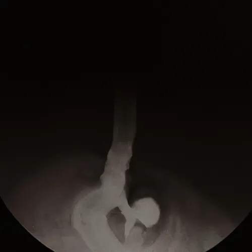 The use of Biopsy Forceps for Endoscopy can help reduce the need for more invasive procedures, as they can often provide sufficient tissue samples for analysis. This minimally invasive approach not only decreases patient discomfort and recovery time but also lowers the risk of complications associated with more invasive methods. Additionally, the ability to obtain real-time tissue samples during endoscopy allows for immediate evaluation by pathologists, enabling timely diagnosis and treatment de