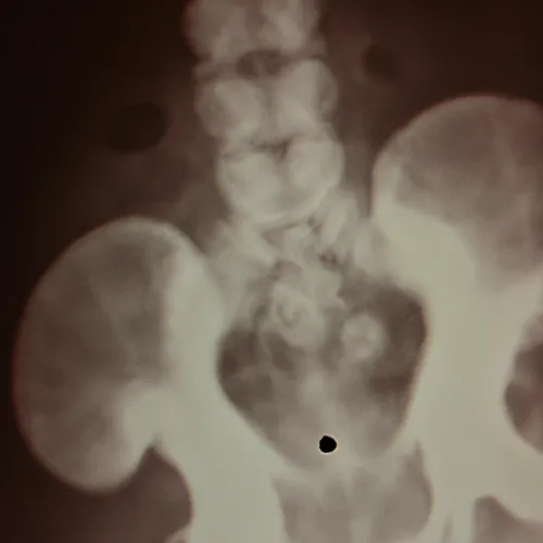 Cold Foreceps Cold Forceps Biopsy Endoscopy