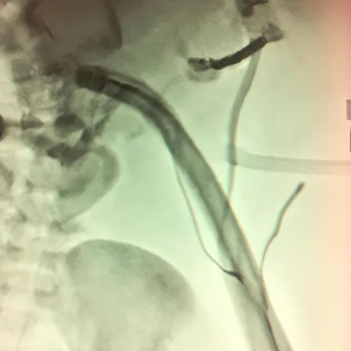 One advantage of endoscopy forceps is their versatility in various medical specialties, including gastroenterology, pulmonology, and urology. They can be used for biopsies, polypectomies, foreign body removal, and tissue sampling, providing clinicians with a multifunctional tool for a wide range of procedures.