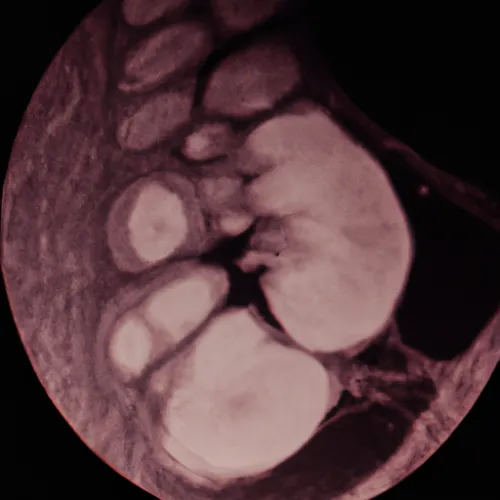 Colposcopy tools also assist in guiding biopsies of suspicious areas, helping to obtain tissue samples for further analysis and diagnosis. This targeted approach can help avoid unnecessary procedures and provide more precise information for developing a treatment plan.