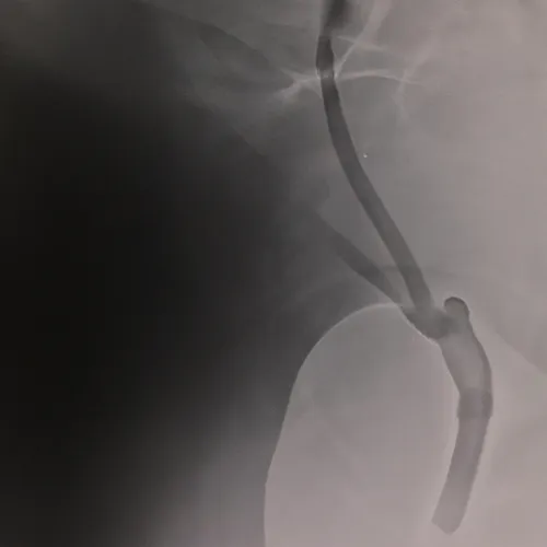 Overall, Biopsy Forceps for Endoscopy offer significant advantages in terms of precision, versatility, and minimally invasive sampling. By facilitating accurate tissue sampling during endoscopic procedures, they contribute to improved diagnostic accuracy, treatment planning, and patient outcomes. These forceps enhance the capabilities of endoscopists in identifying and monitoring various pathologies, ultimately leading to better patient care and management. Their use is essential in modern endos