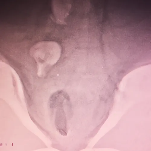 One key advantage of cervix biopsy forceps is their precision and control during the biopsy procedure. The design of these forceps allows for targeted sampling of tissue, reducing the risk of damage to surrounding healthy tissue and ensuring accurate results. This precision is crucial in diagnosing conditions such as cervical cancer and cervical dysplasia.