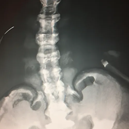 Endoscopy forceps are essential tools used in minimally invasive procedures to grasp, manipulate, and remove tissue during endoscopic examinations. These instruments allow for precise control and dexterity in accessing hard-to-reach areas of the body, making them crucial for diagnostic and therapeutic interventions.