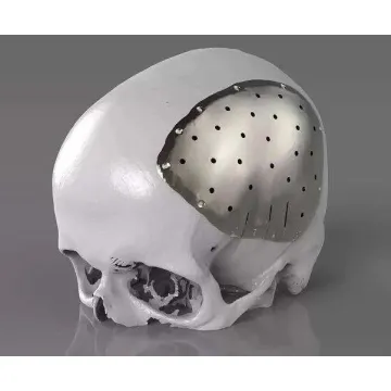Titanium skull implants