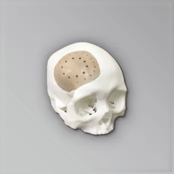 peek skull implant