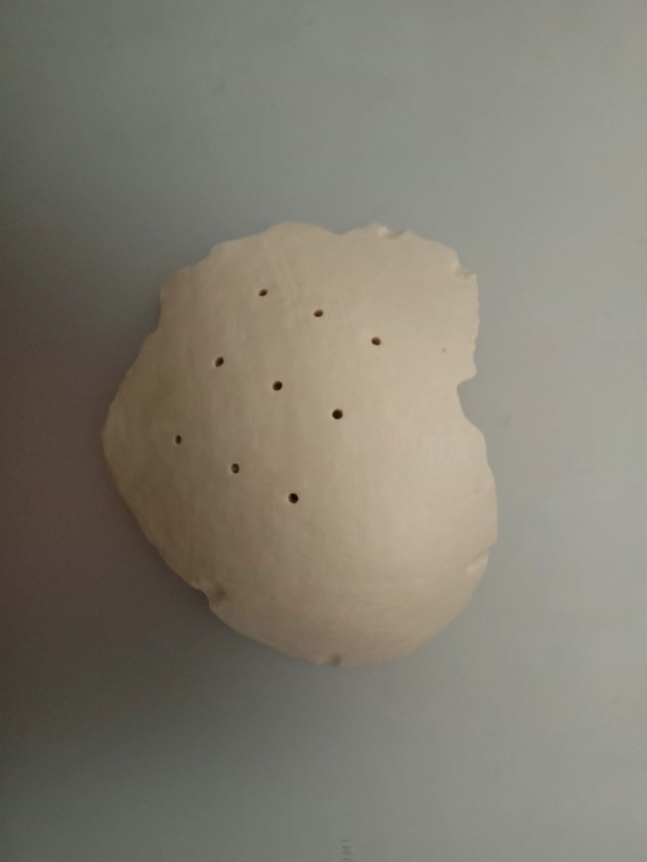 颅骨成形术示例-53：3D打印PEEK颅网植入物