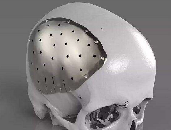 3D Printed Prostheses: Selection of Cranial Repair Materials
