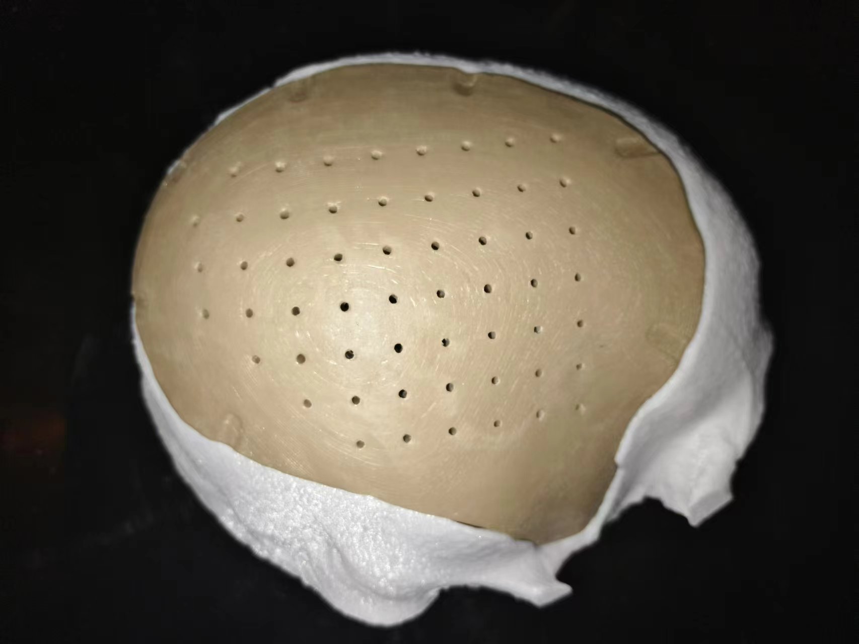 3D Printed PEEK Cranial Implants: An Innovation in Cranioplasty