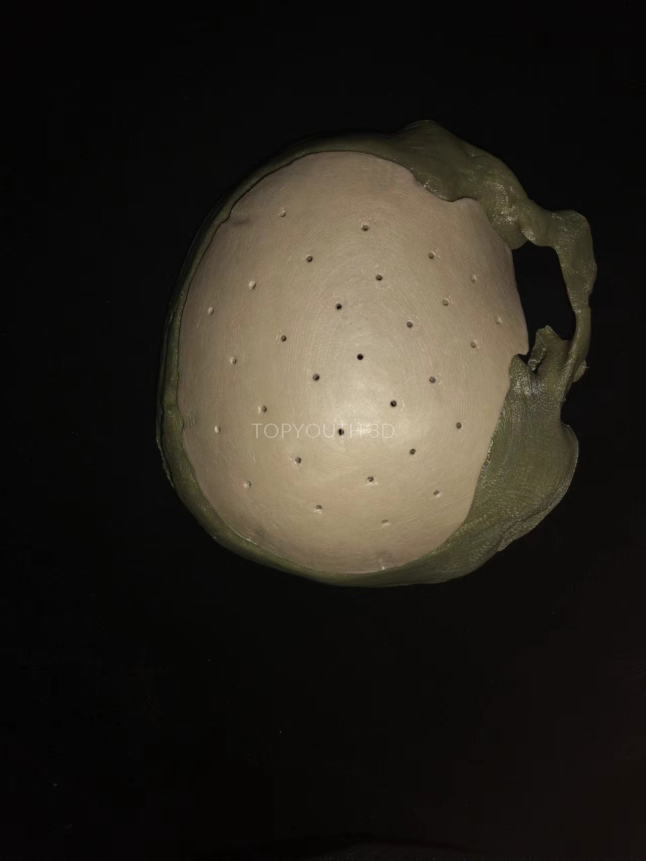 PEEK skull plate - example 47