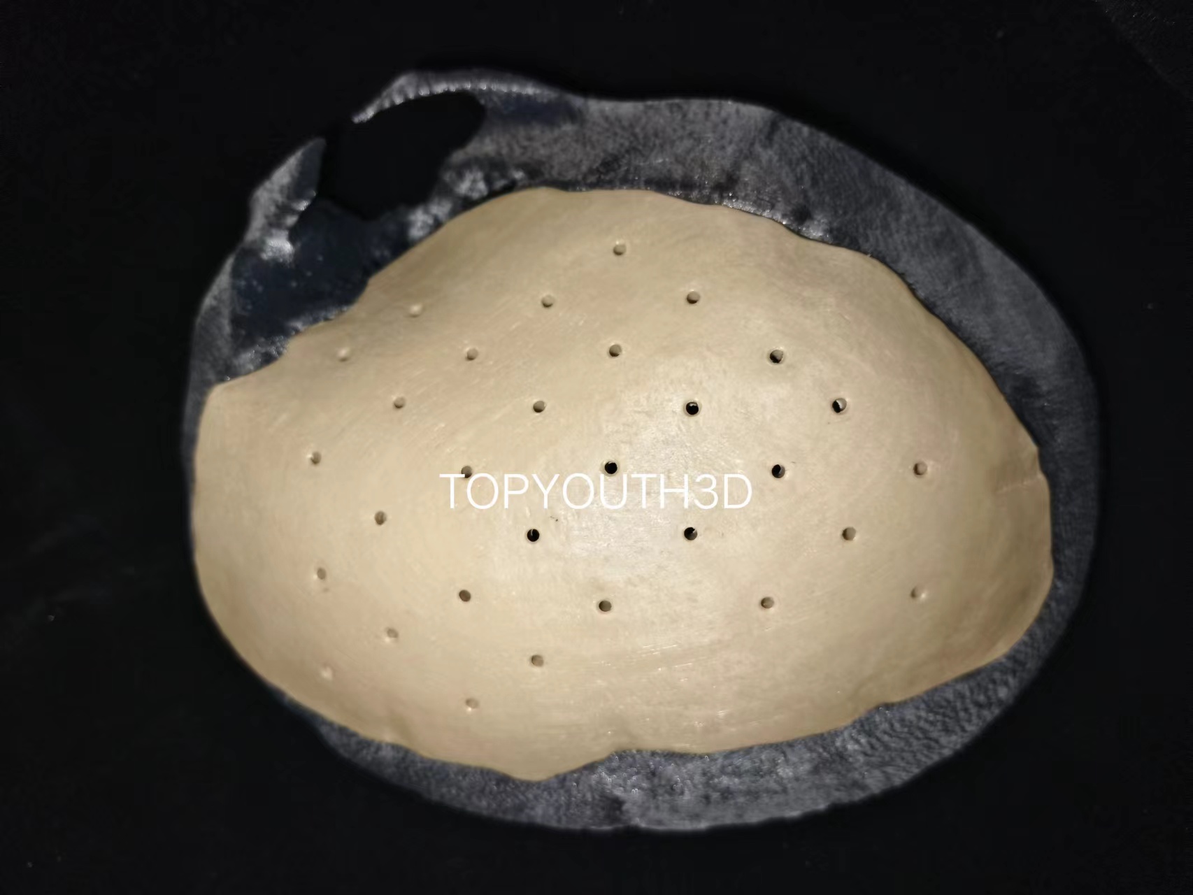 PEEK skull plate - example 48