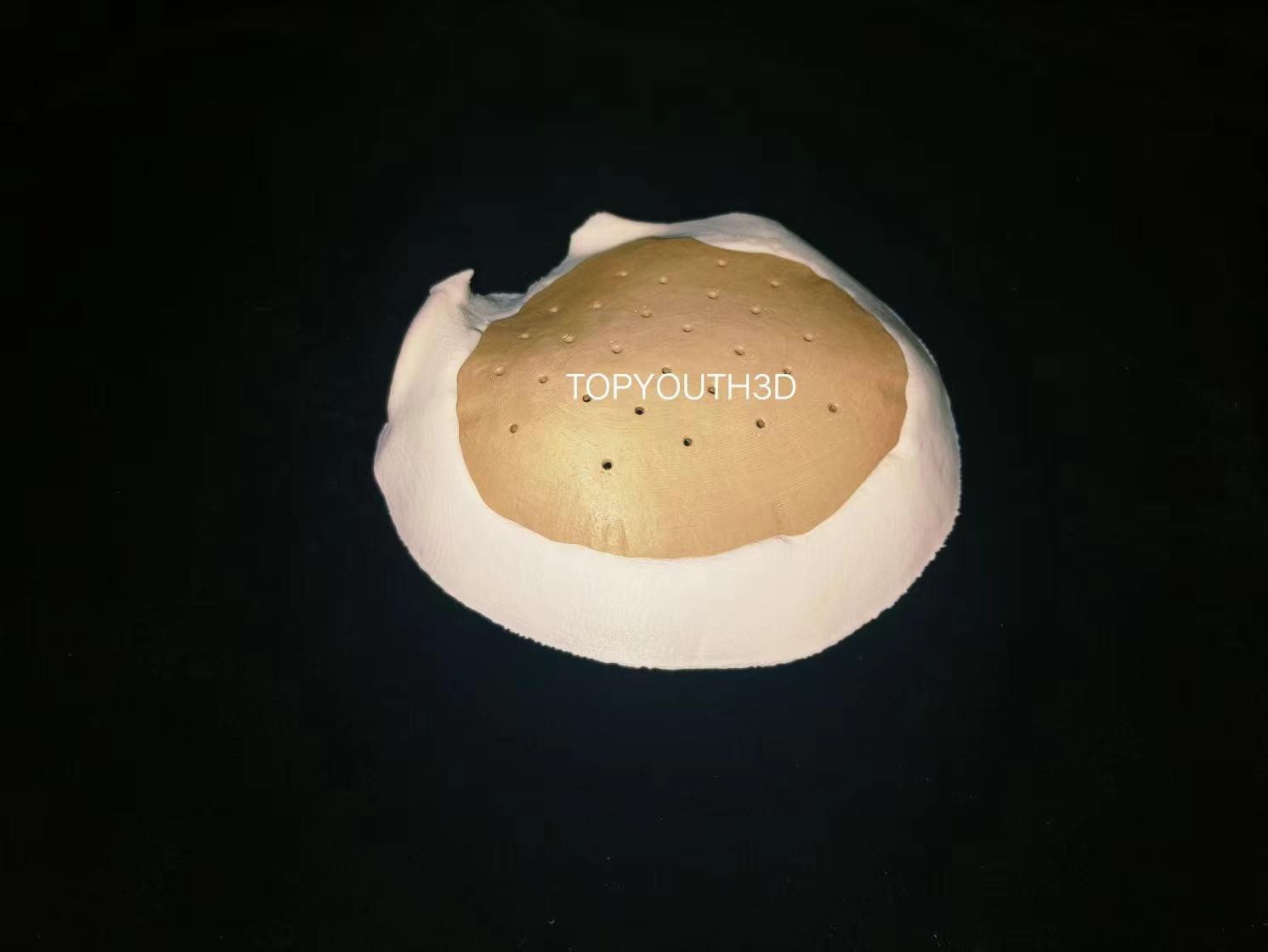 3D打印PEEK颅骨植入物：颅骨成形术的革新