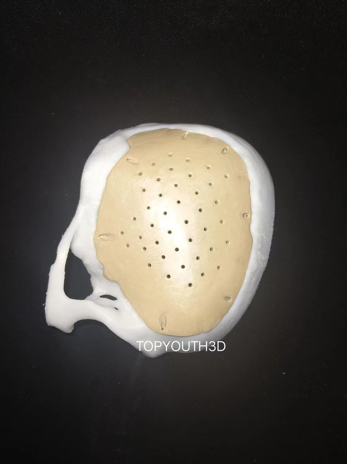 3D打印PEEK在医疗领域的应用