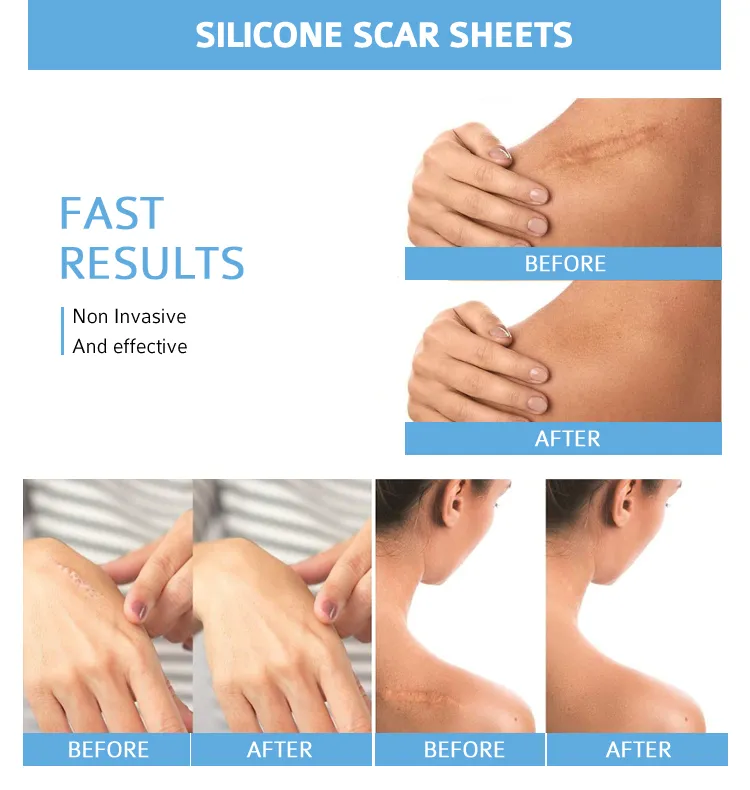 Professional Silicone Scar Sheets Reusable