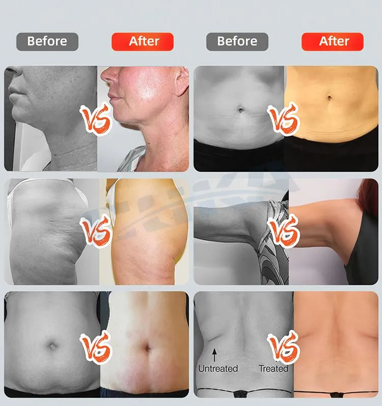 Velashape Slimming Machine