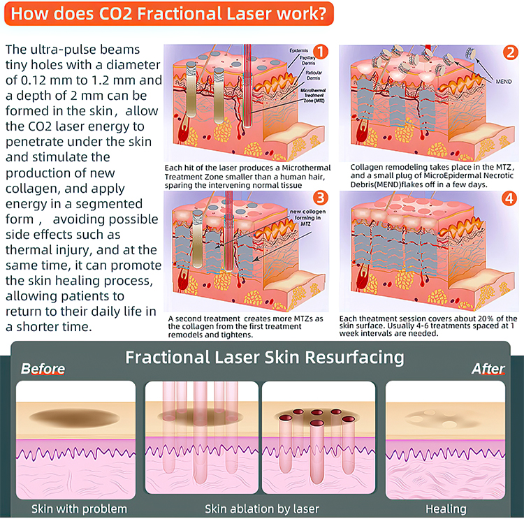 3 in 1 Co2 Fractional Laser