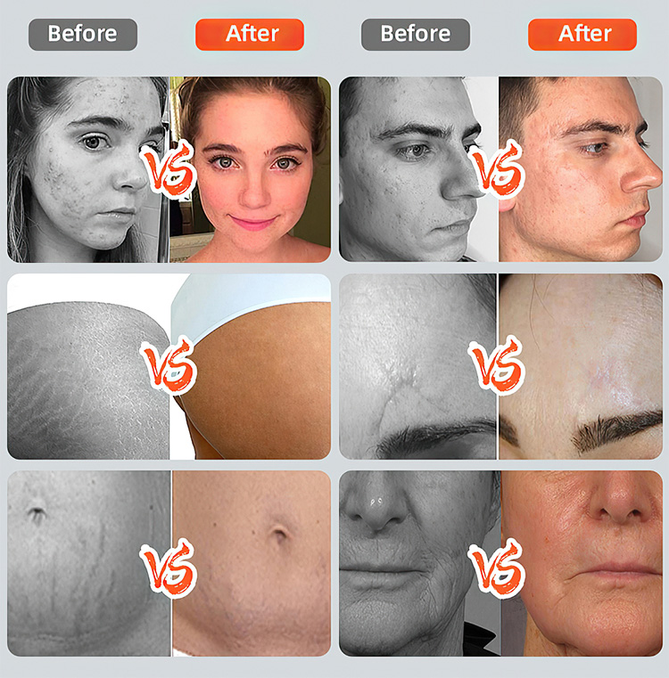 3 in 1 Co2 Fractional Laser