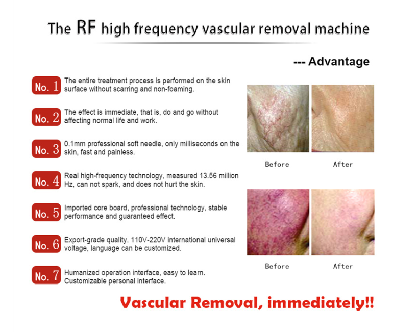 RF Vascular Removal Machine