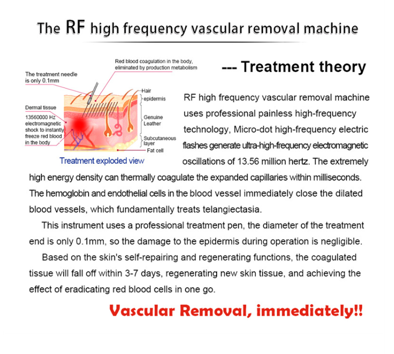 RF Vascular Removal Machine