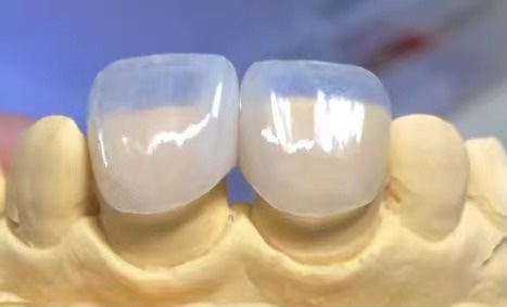 E.AX Veneer Exporter, Ultimate Dental Laboratory