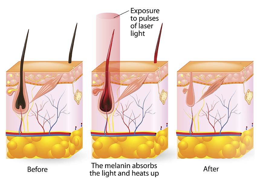 About Diode Laser Hair Removal Treatment: What You Need to Know