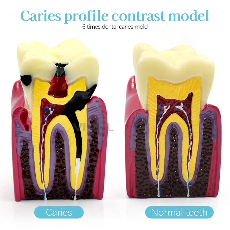 Caries Teaching & 24pcs Dental Teeth Model