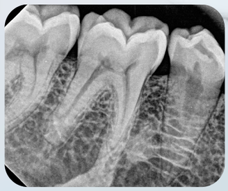 Dental sensor E-sensor