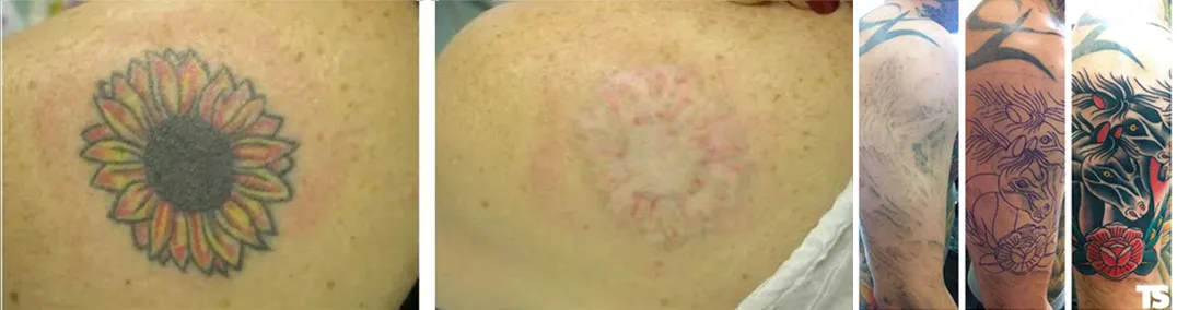 Comprimento de onda da máquina 4 da remoção da tatuagem do picosegundo