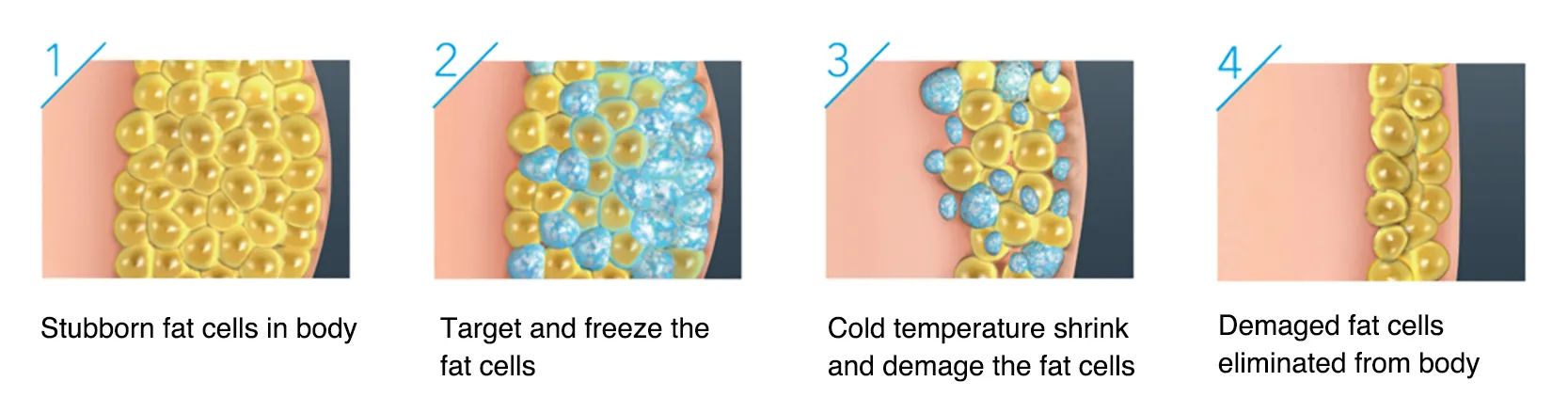 Working Principle of Cryolipolysis Coolsculpting Fat Freezing Machine