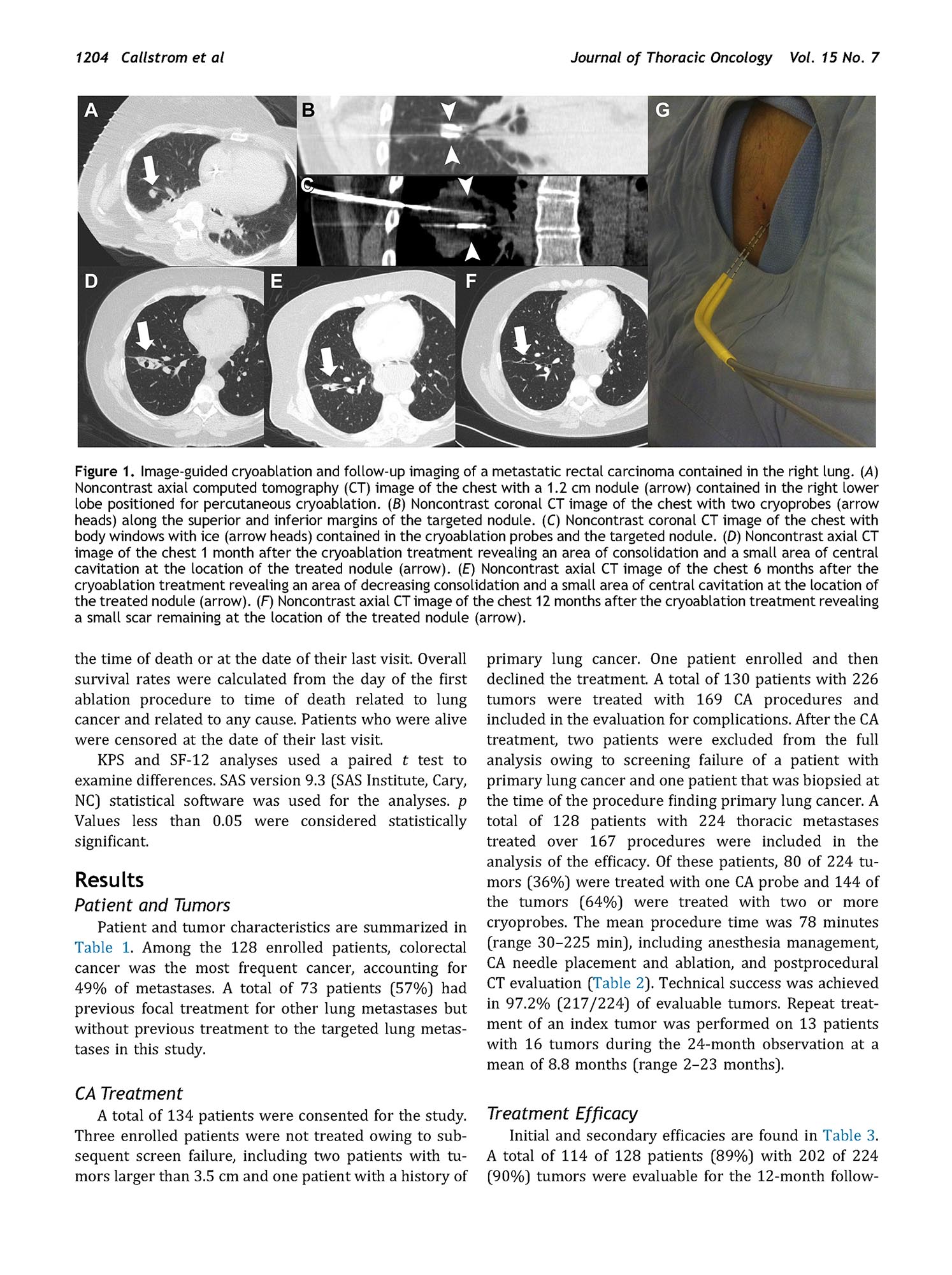 Multicenter Study of Metastatic Lung Tumors Targeted by Interventional Cryoablation Evaluation (SOLSTICE)