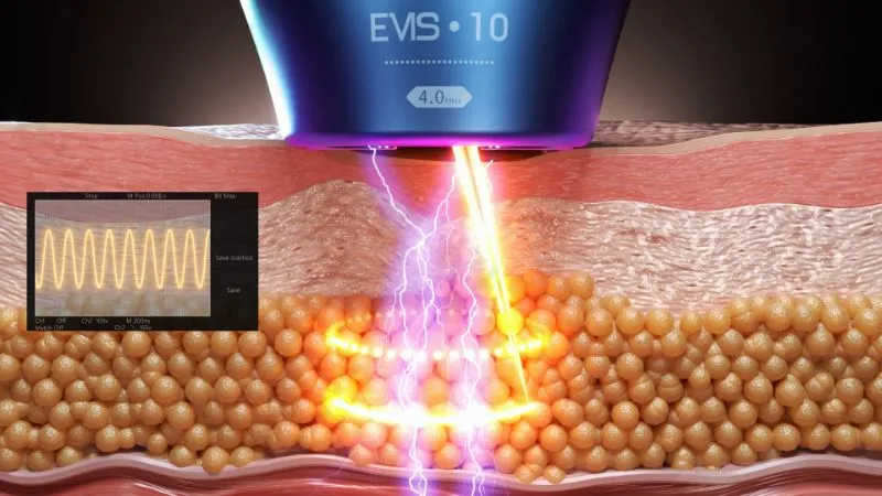 Highlight Features of Meizi's HIFU Machine Highlight Features of Meizi's HIFU Machine