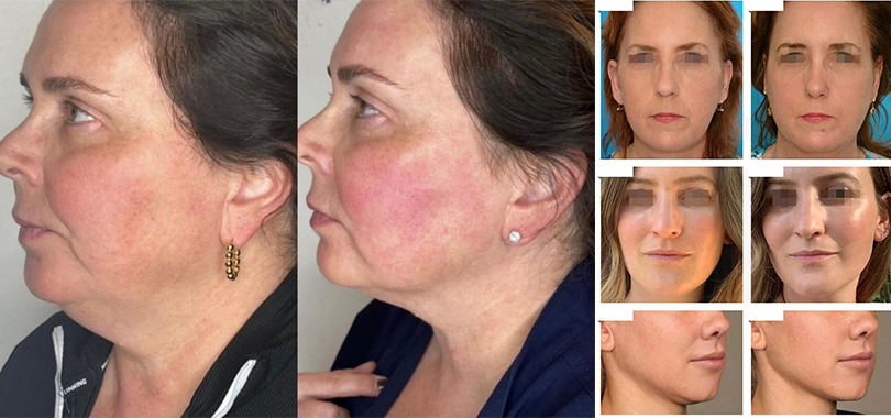 New trend : PE FACE facial muscle toning