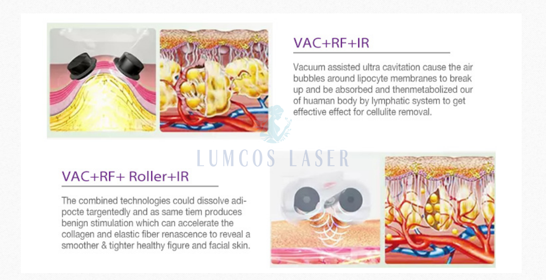 velashape, body shape roller machine