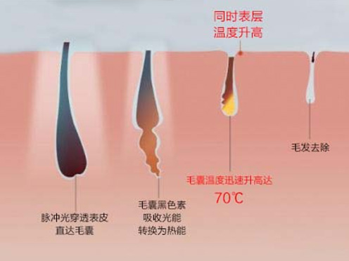 Several Common Problems Encountered in Hair Removal