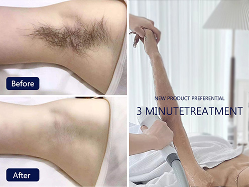 Precautions for Using Hair Removal Equipment
