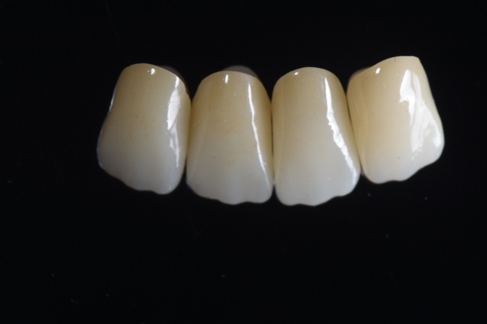 Pick Your New Crown: Zirconia and Gold