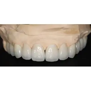 A dental crown is a popular temporary tooth restoration treatment.