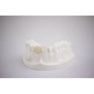 Zirconia crowns tend to cause less stress and damage on opposing pieces than their porcelain counterparts.