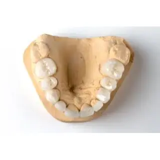 Most dental crowns last between five and fifteen years when treated with care.