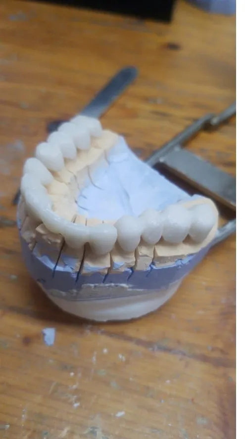 Comparison of Dental Bridges and Dental Implants