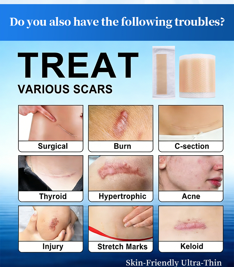 silicone scar sheets,scar away silicone scar sheets,silicone scar tape ...