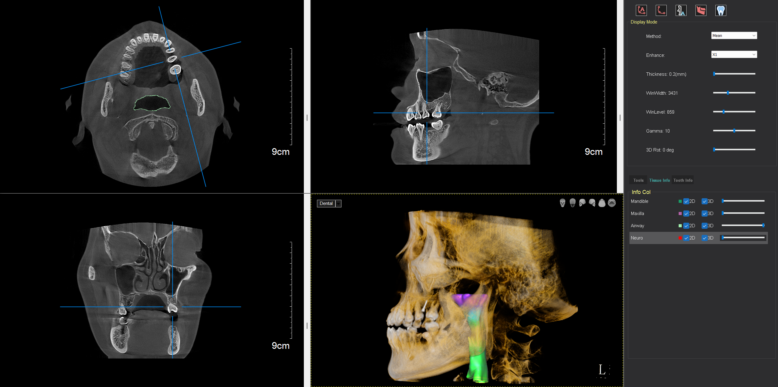 Airway Volume Analysis Software in Orthodontics