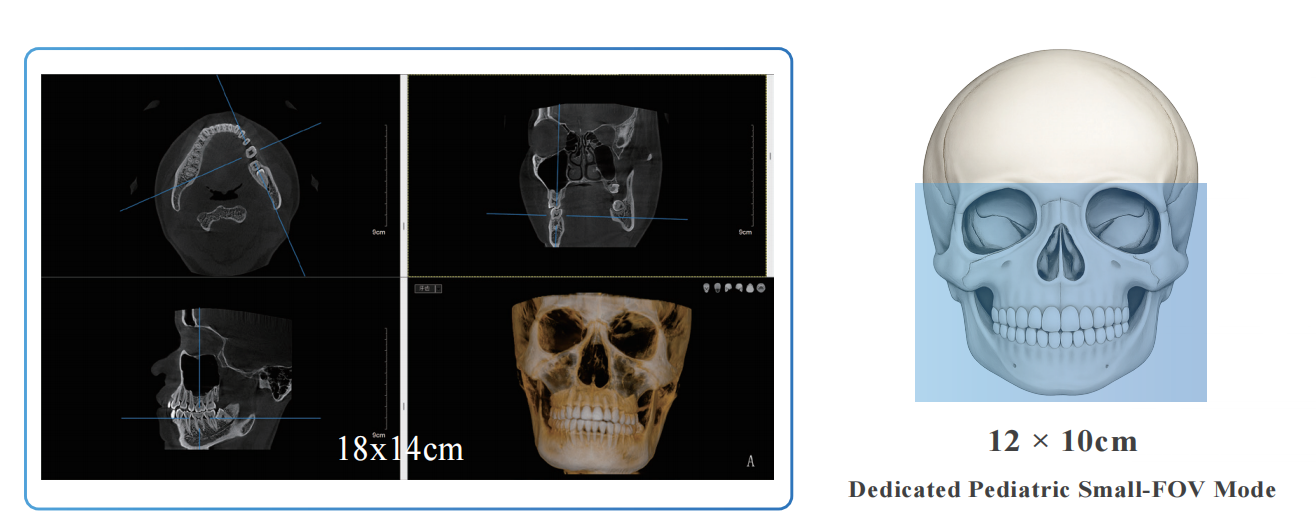 Por qué la CBCT pediátrica exige un campo de visión dedicado: comprender la colimación de 12×10 cm y la optimización de la dosis de radiación