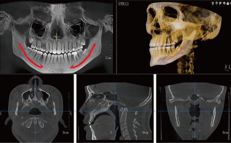 Bright Moon 2.0 Dental CBCT: Elevating Precision and Safety in Digital Implantology | Ryder Medical
