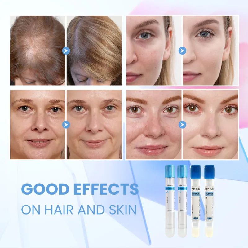 PRP Therapy – Platelet-Rich Plasma Treatment
