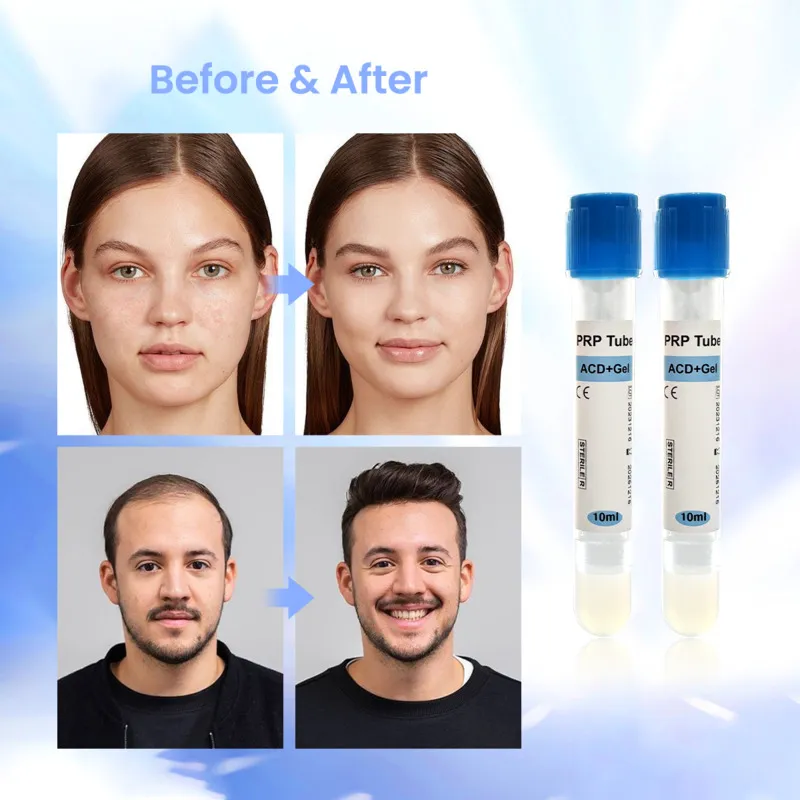 PRP Therapy – Platelet-Rich Plasma Treatment