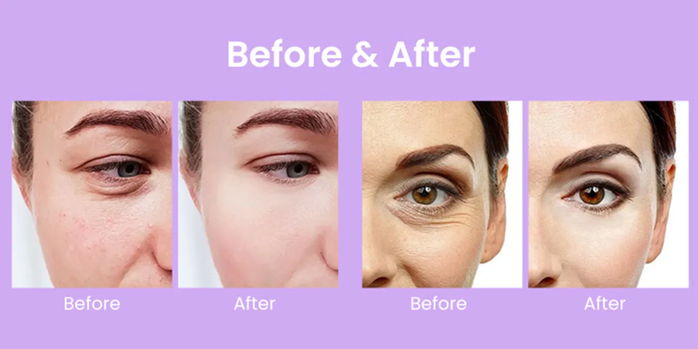 Volume Restoration – Dermal Filler Injection